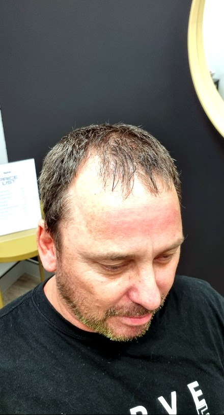 Client before their Tuffs hair system